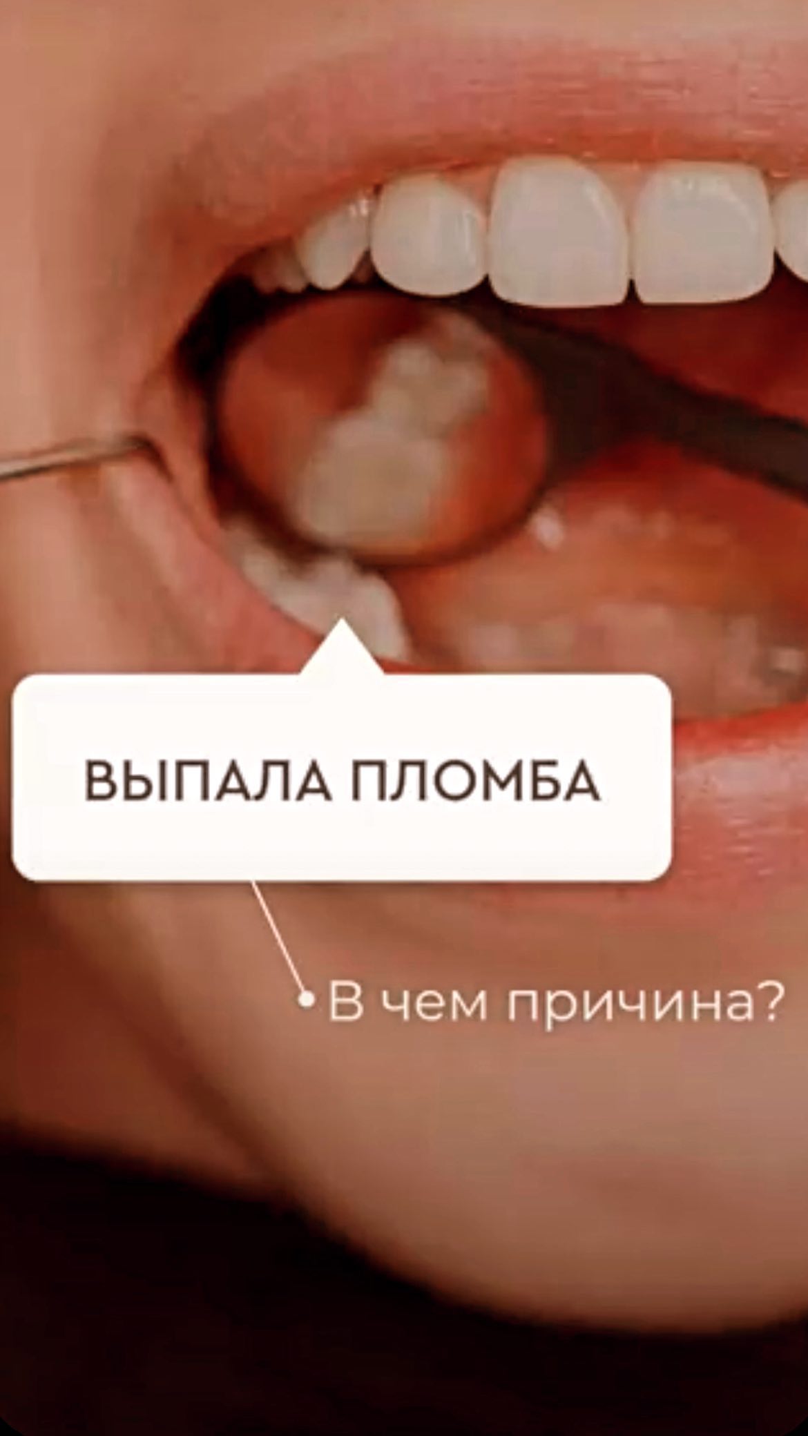 Циркониевые коронки