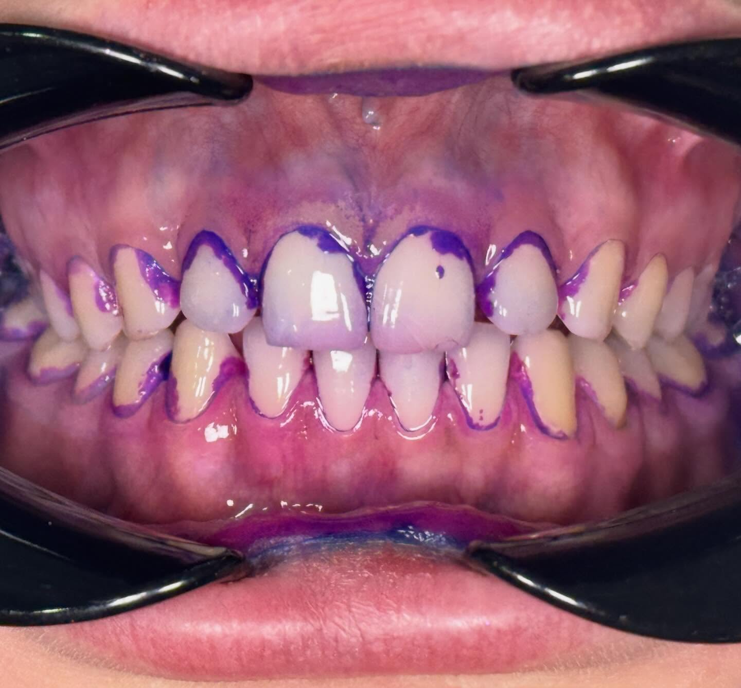 Чистка зубов